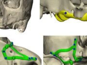 Els implants subperiòstics es consoliden com a solució per a maxil·lars severament atròfics